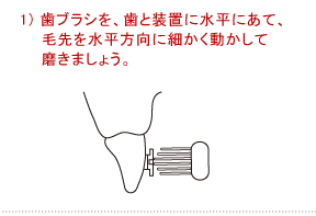 1）歯ブラシを、歯と装置に水平にあて、毛先を水平方向に細かく動かして磨きましょう。